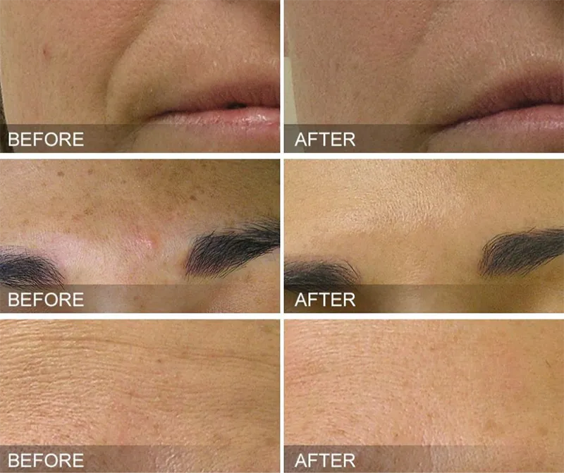 Premium Hydrafacial